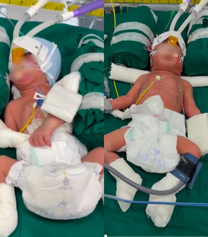 Preterm Twins Of Mrs Artika Sanket Thombre